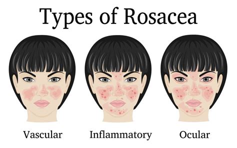 Rosácea Van Caester Dermatologia