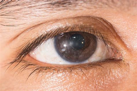 Keratitis - New Jersey Eye Center