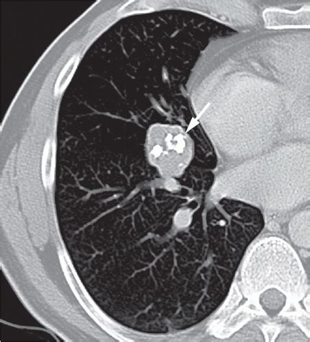 Benign Lung Tumor