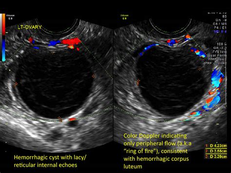 Hemorrhagic ovarian cysts: One entity with many appearances | MDedge ObGyn