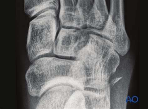 Cuboid avulsion fracture