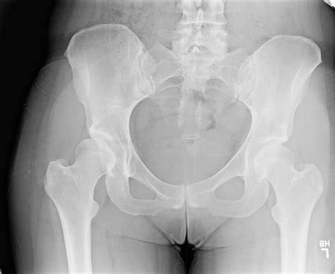 Ortho Dx: A woman with a hip that is popping out of place - Clinical Advisor