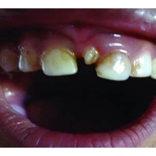 (a) Showing mesiodens in upper arch. (b) Radiograph showing rotated... | Download Scientific Diagram