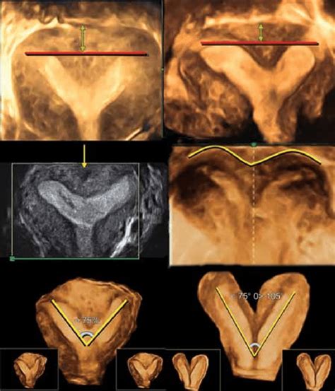 Bicornuate Uterus Ultrasound