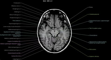 Anatomy Of Brain In Mri