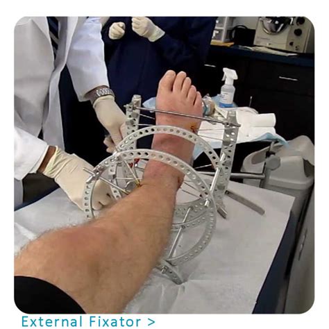 External Fixator - Orthopedic Implants Manufacturer & Suppliers | UTESHIYA MEDICARE