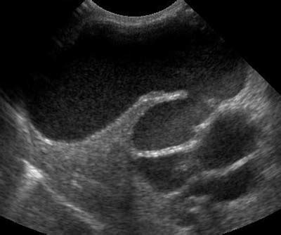 Biliary obstruction