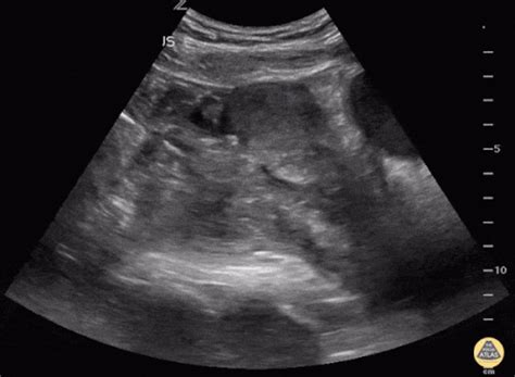 Differential Diagnosis of Ultrasound in Ectopic Pregnancy