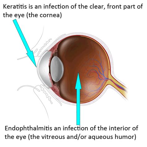 Definition of Fungal Eye Infections | Types of Diseases | Fungal ...