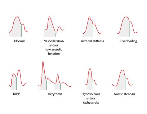 PRAM method – Hemodynamic Management / Vygon