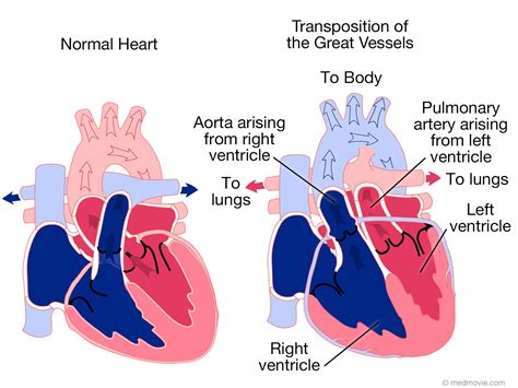 Transposition of the Great Arteries; d-TGA & L-TGA (congenitally ...