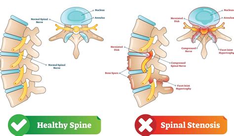 FORAMINAL STENOSIS - Texas Spine Care Center