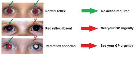 Lazy Eye - Amblyopia - Causes, Treatment on How To Fix a Lazy Eye