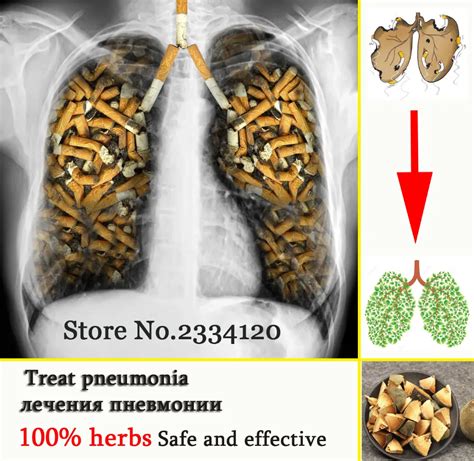 Chinese Herbs Powerful Treat Pneumonia And Treatment Of Lung Disease Caused By Smoking Reduce ...