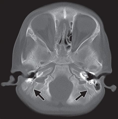 CT of Normal Developmental and Variant Anatomy of the Pediatric Skull ...