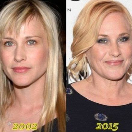 Plastic Surgery Made Patricia Arquette's Forehead Smoother