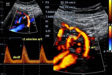 Uterine arteries arterial collaterals | Image | Radiopaedia.org