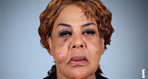 Rajee Narinesingh had face pumped with cement – this is her today