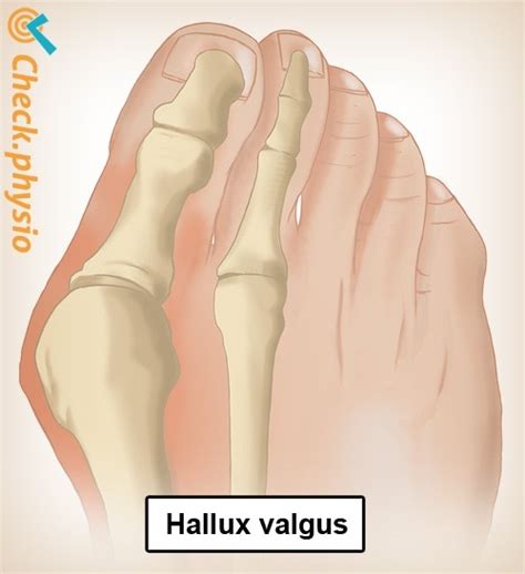 Hallux valgus (bunion) | Physio Check