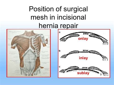 Abdominal Wall Hernias - online presentation