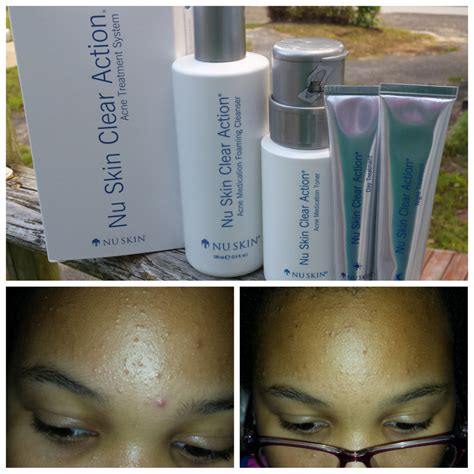 Help Clear Up Acne Using Nu Skin Clear Action Acne Medication System ...