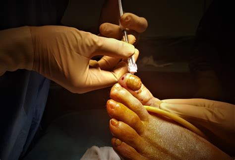 Toenail Removal Surgery - Everything You Need to Know | GNFO