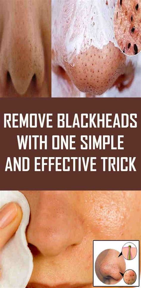 Remove Blackheads With One Simple And Effective Trick - Fitness And ...