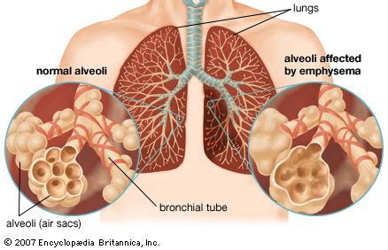 Emphysema treatment, symptoms and natural emphysema treatment tips