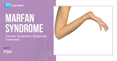 Marfan Syndrome: Causes , Symptoms, Diagnosis, Treatment