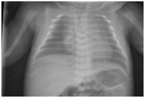 Clinical, radiological and genetic analysis of a male infant with neonatal respiratory distress ...