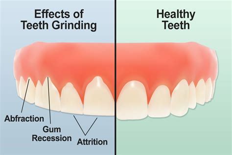 FACT SHEET: TEETH GRINDING/BRUXISM