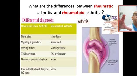 what are the differences between rheumatic fever arthritis and ...