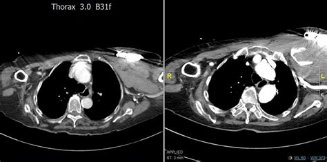 Computed tomography scan of the thorax with intravenous contrast ...