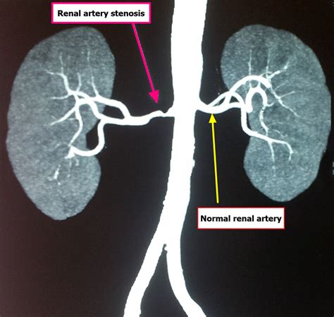 Renal Artery Function - Renal artery stenosis and Renal artery aneurysm