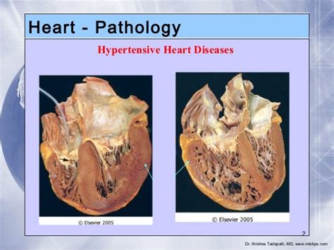 4. heart pathology; hypertensive heart diseases