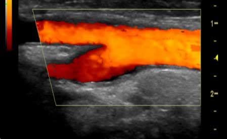 Carotid Duplex/Doppler