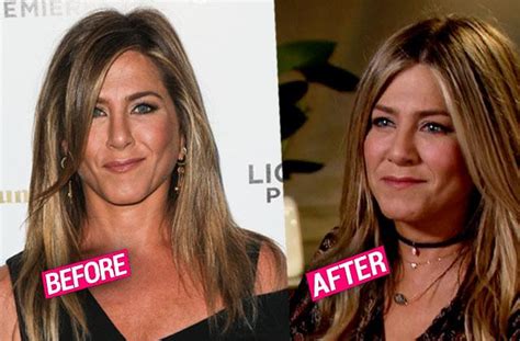 More Plastic Surgery? Jennifer Aniston Gets Fillers For Plumper Cheeks, Doctor Says