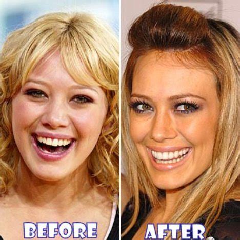 Hilary Duff Plastic Surgery Before and After Breast Implants, Nose Job and Teeth dental ...