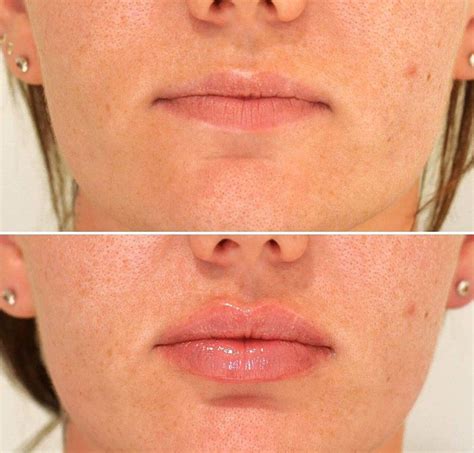 Pin by Madison Jones on Bleh | Lip fillers, Botox lips, Lips inspiration