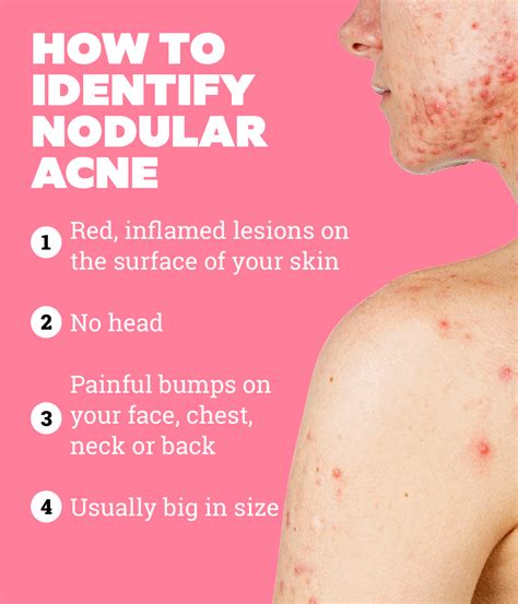 What is nodular acne and how to treat it