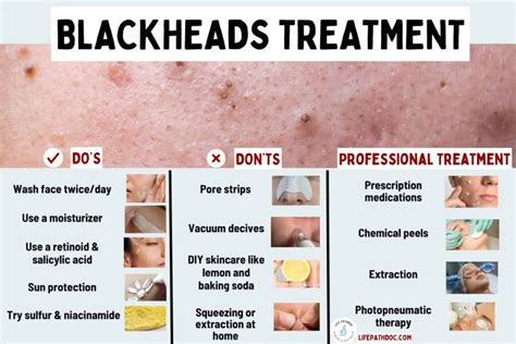 How to Get Rid of Blackheads: Do's and Don'ts