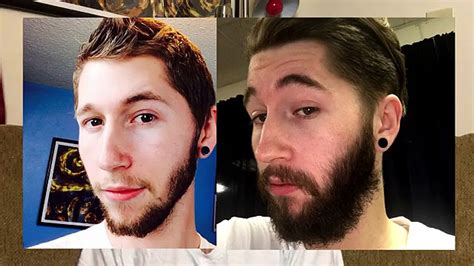 Minoxidil Beard Before And After