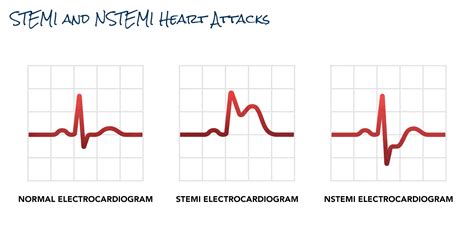 Heart Attack | SCAI - Seconds Count