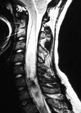 Neural Tube Defects Treatment & Management: Approach Considerations, Medical Care, Surgical Care