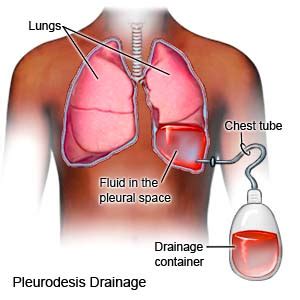 Chemical Pleurodesis - What You Need to Know