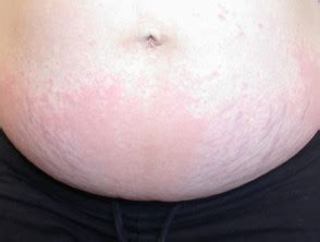 Polymorphic Pregnancy Rash - Dermatly.com - Il sito della tua pelle