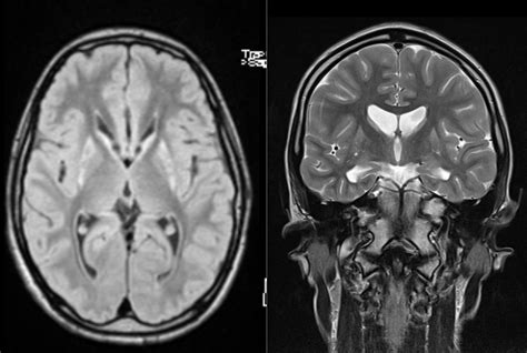 Huntington Disease