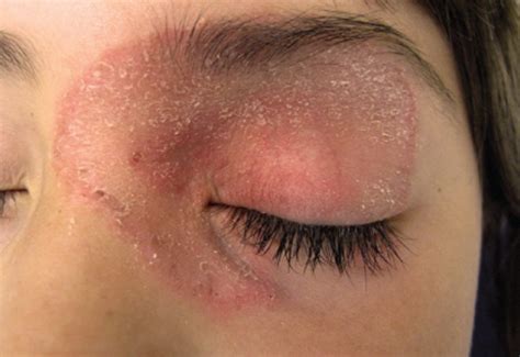 Rash on Eyelid - Pictures, Causes and Treatment