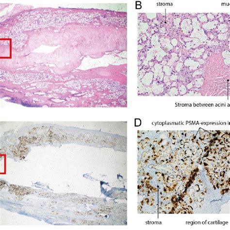 Torus tubarius with overlying gland histology and immunohistochemistry.... | Download Scientific ...