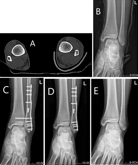 CT and X-ray images of syndesmotic screw fixation. Notes: This patient... | Download Scientific ...